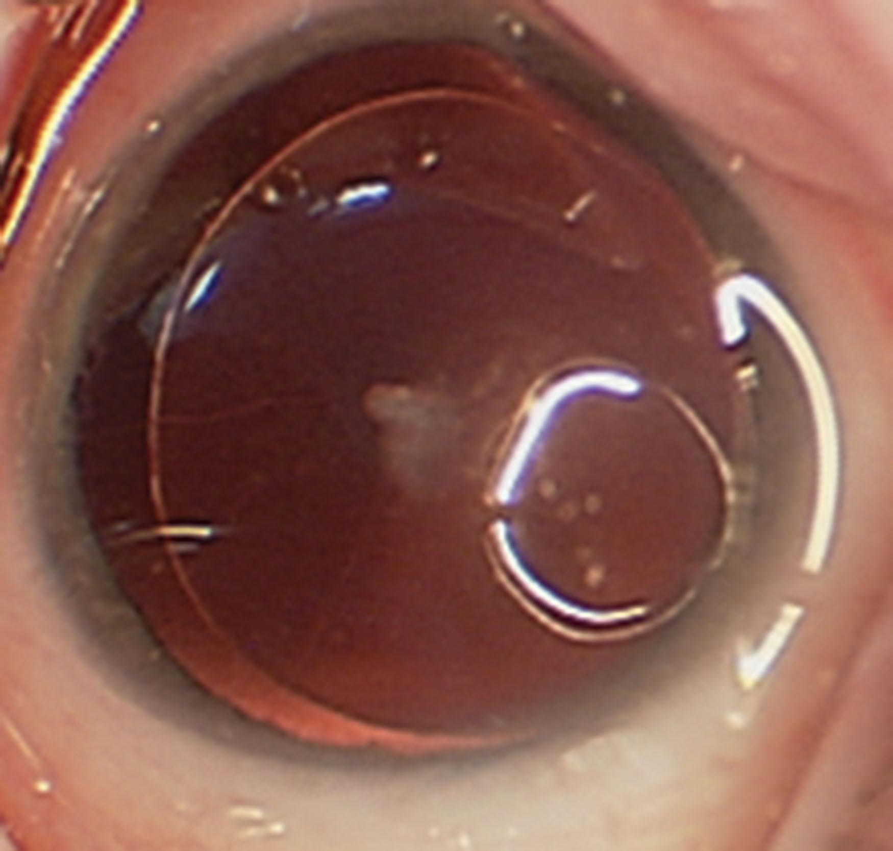 Fig. 37.3, Aniridia. Only the iris root is visible.