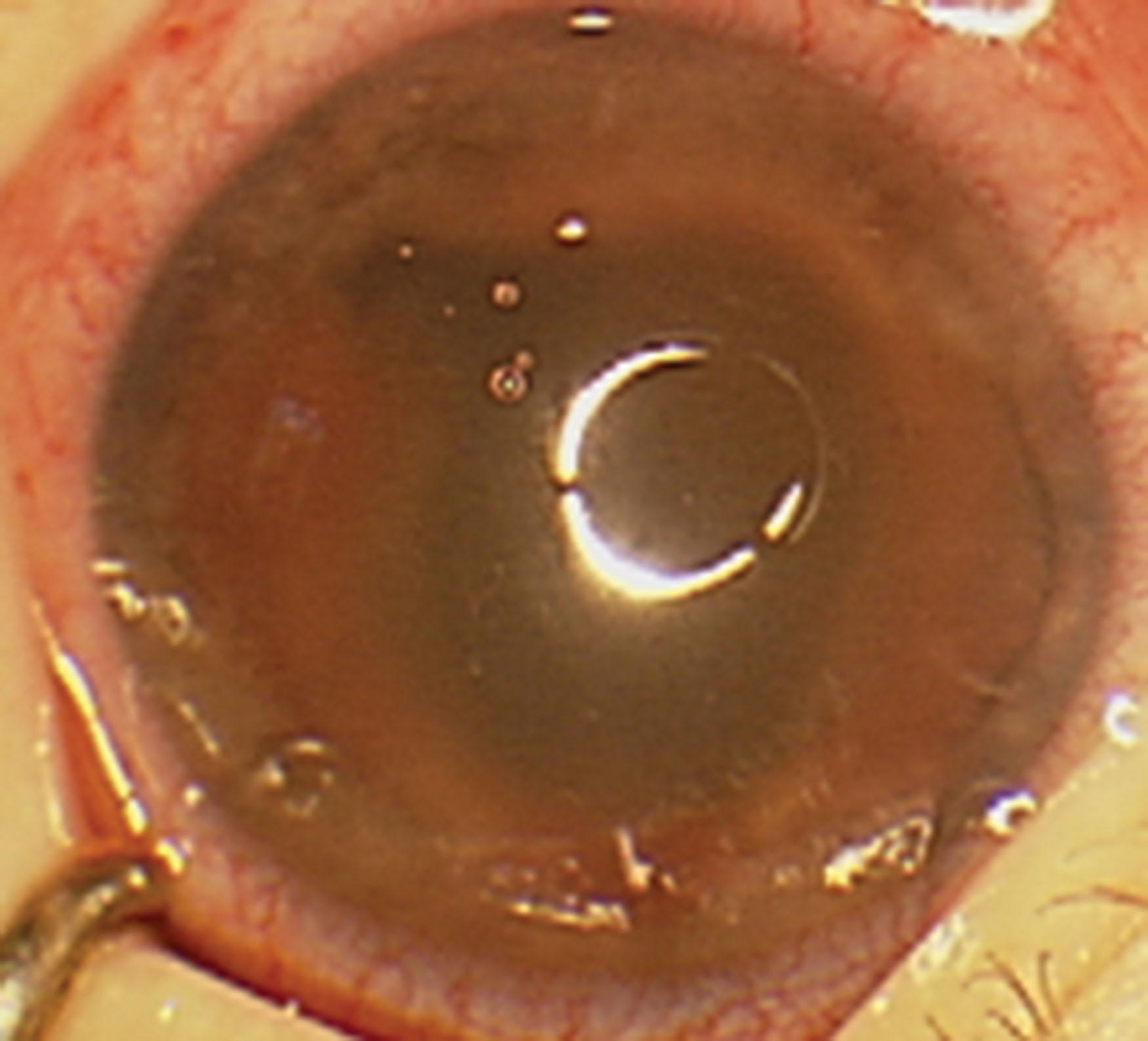 Fig. 37.5, Ectropion uveae in NF1. The iris peripheral to the ectropion has a flat surface with loss of crypts suggestive of membrane which may also occlude the angle in that meridian.