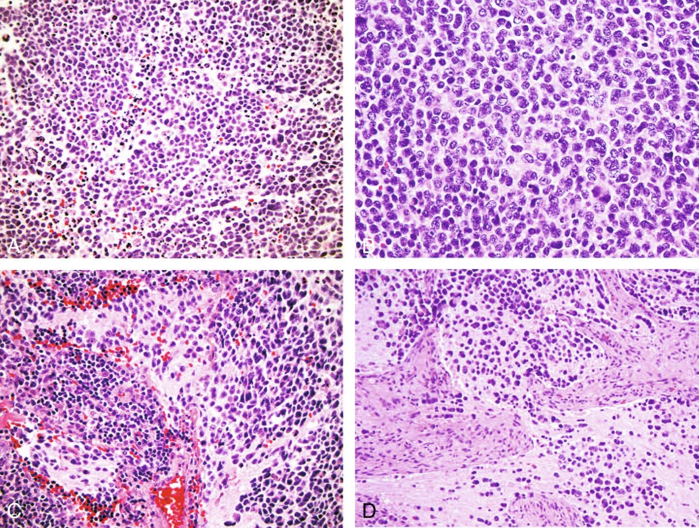 Figure 22.1, Histology of neuroblastoma (NB).