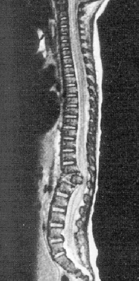 Fig. 43.1, Magnetic resonance image of a fracture-dislocation of the spine occurring in a 10-month-old infant who was the victim of child abuse.