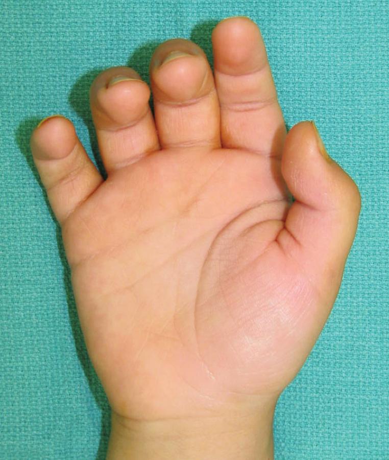 FIGURE 105.1, Trigger thumb with IP joint flexion. IP , Interphalangeal.