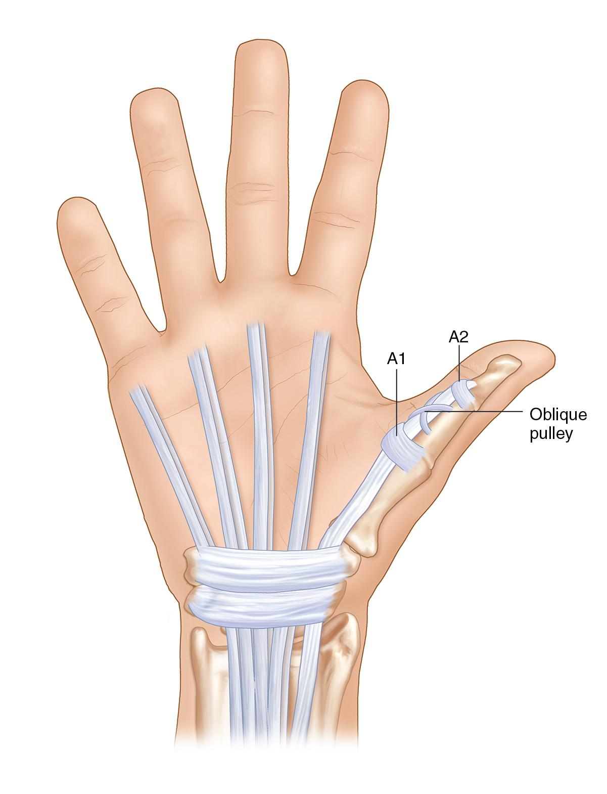 FIGURE 105.3, Anatomy of the thumb flexor tendon sheath.