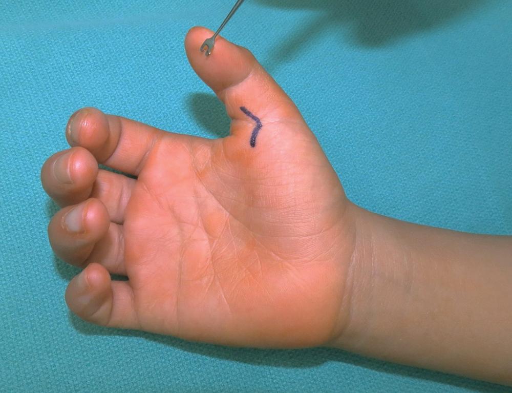 FIGURE 105.5, A 1-cm marking over the flexion crease at the thumb MCP joint. MCP , Metacarpophalangeal.