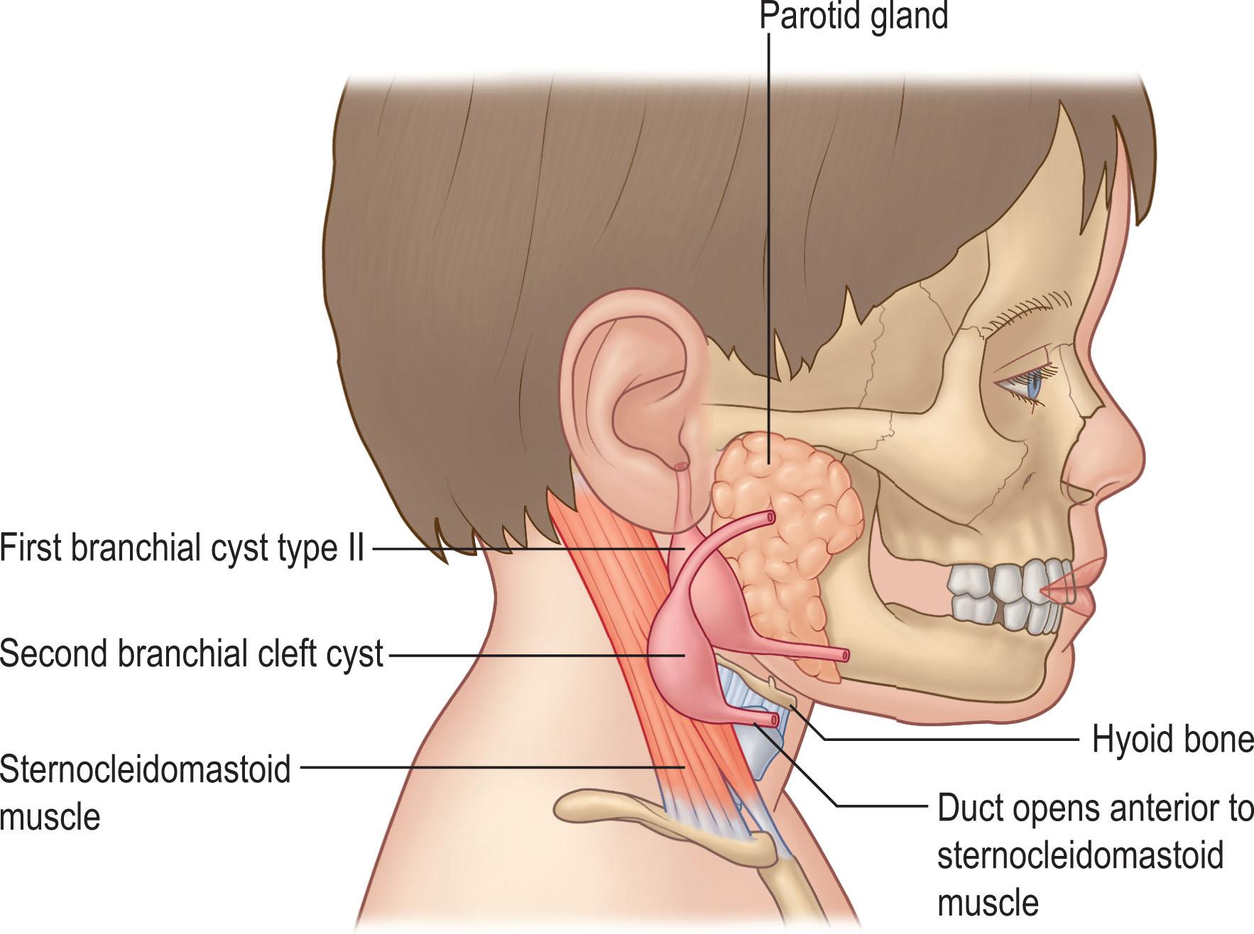 Figure 33.1, Branchial cleft.