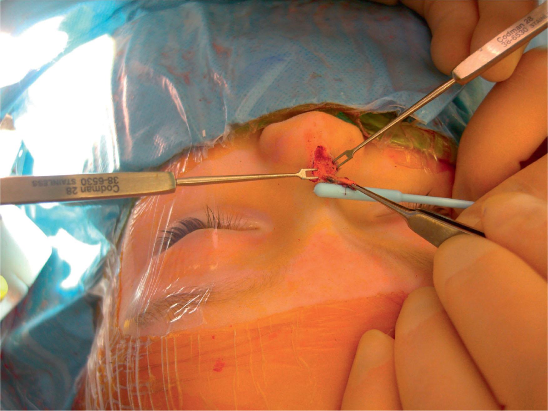Figure 33.5, Direct excision of nasal dermoid without intracranial extension.