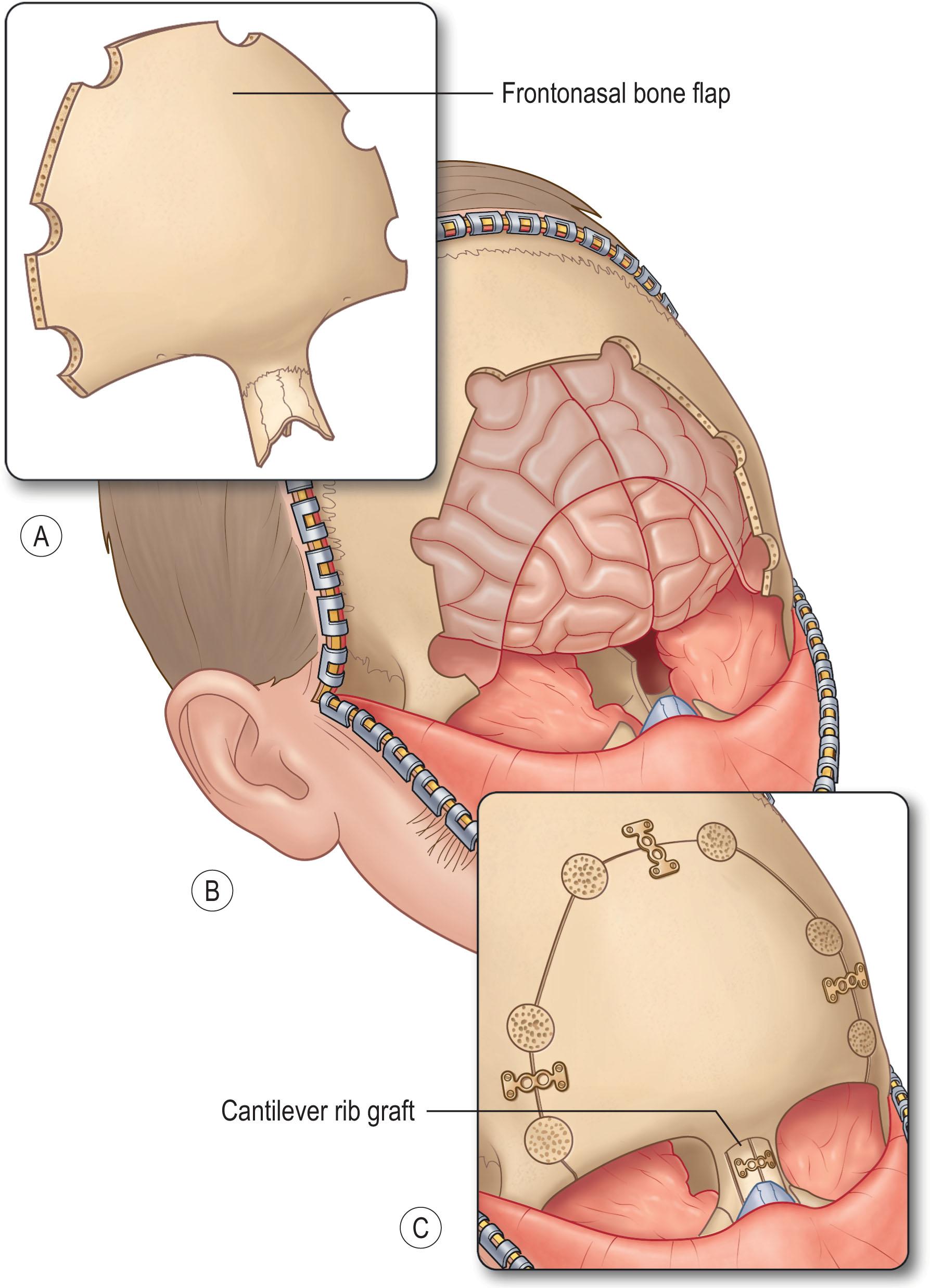 Figure 33.6, Subcranial approach to intracranial dermoids. (A) Frontonasal bone fragment. (B) Subcranial approach with simultaneous access to the frontal lobe, the anterior skull base, and the nasal cavity. (C) Reconstruction with replacement of the frontonasal bone fragment, cantilever rib grafts to the nasal dorsum, and orbital floor reconstruction with split calvarial bone graft.