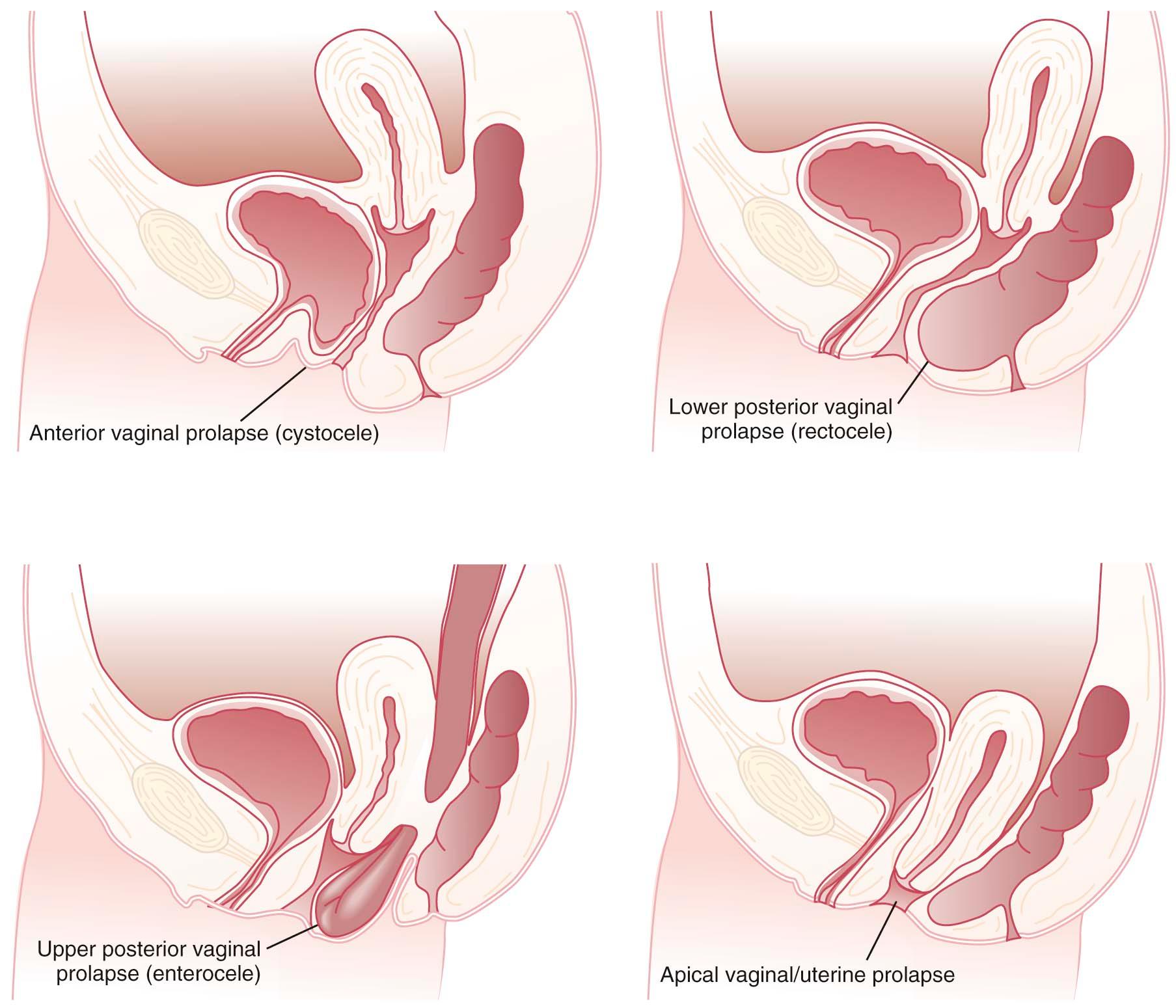 FIGURE 23-1, Diagrammatic representation of the four types of vaginal uterine prolapse.