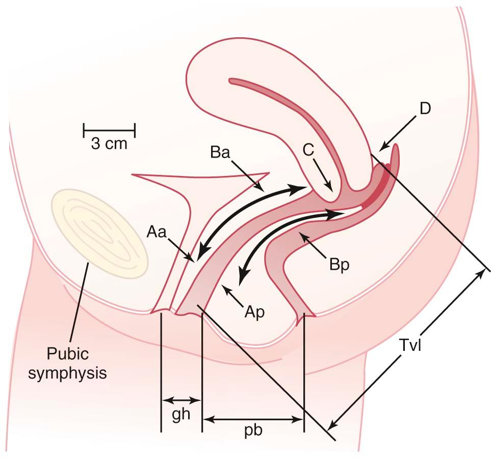 FIGURE 23-3, Illustration showing a side view of the female pelvis. Six sites (points Aa, Ba, C, D, Bp, and Ap), genital hiatus (gh), perineal body (pb), and total vaginal length (Tvl) used for pelvic organ support quantitation.