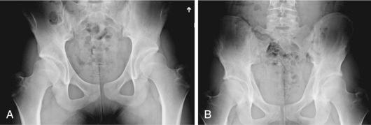 Fig. 55.1, (A) Anteroposterior pelvic radiograph of an adolescent female with bilateral acetabula dysplasia. (B) Same patient 2 years following staged, bilateral periacetabular osteotomies.