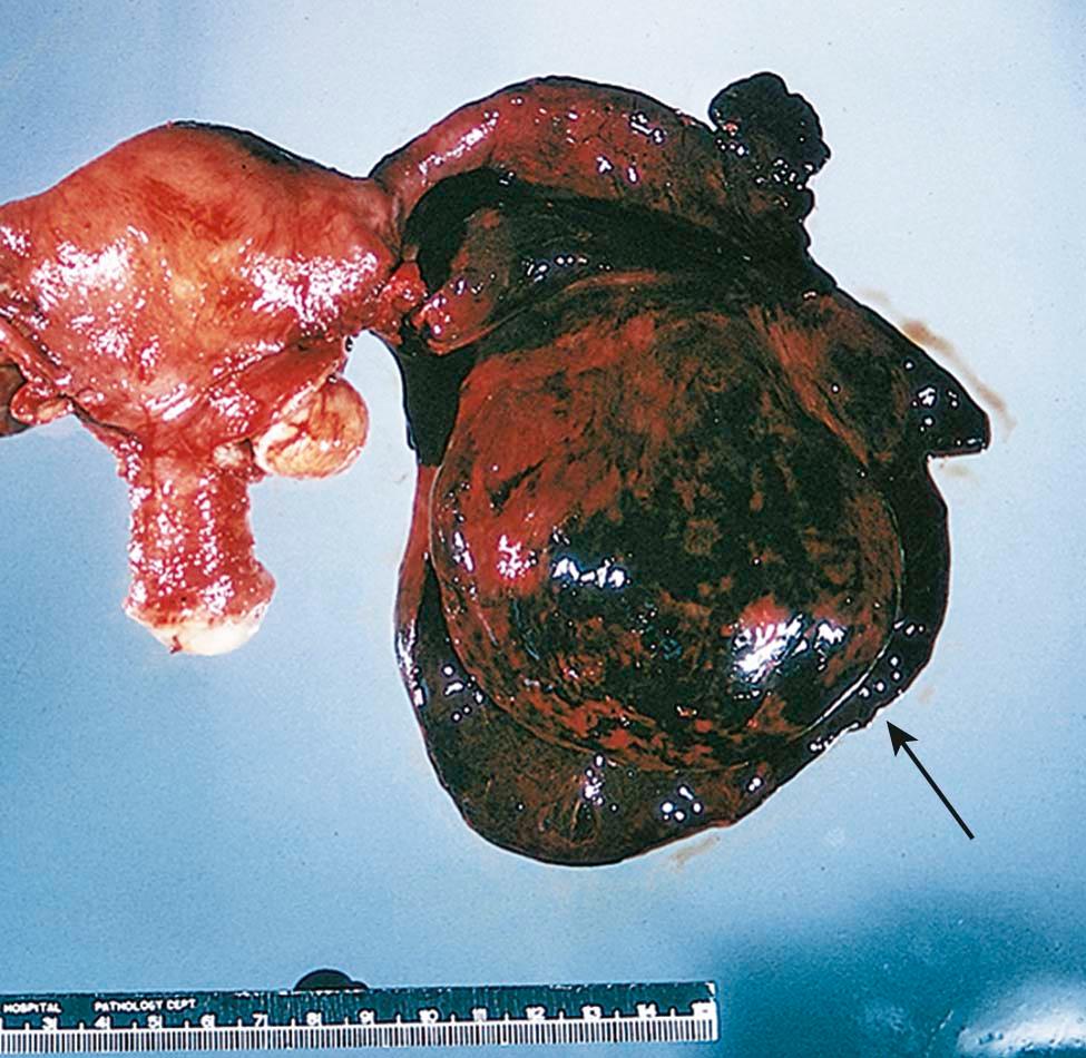 FIGURE 21-1, Torsion of an ovarian cyst and adnexal blood vessels. Note the large clot that has formed in the adnexal area (arrow) due to obstruction of venous outflow from a left ovarian cyst.