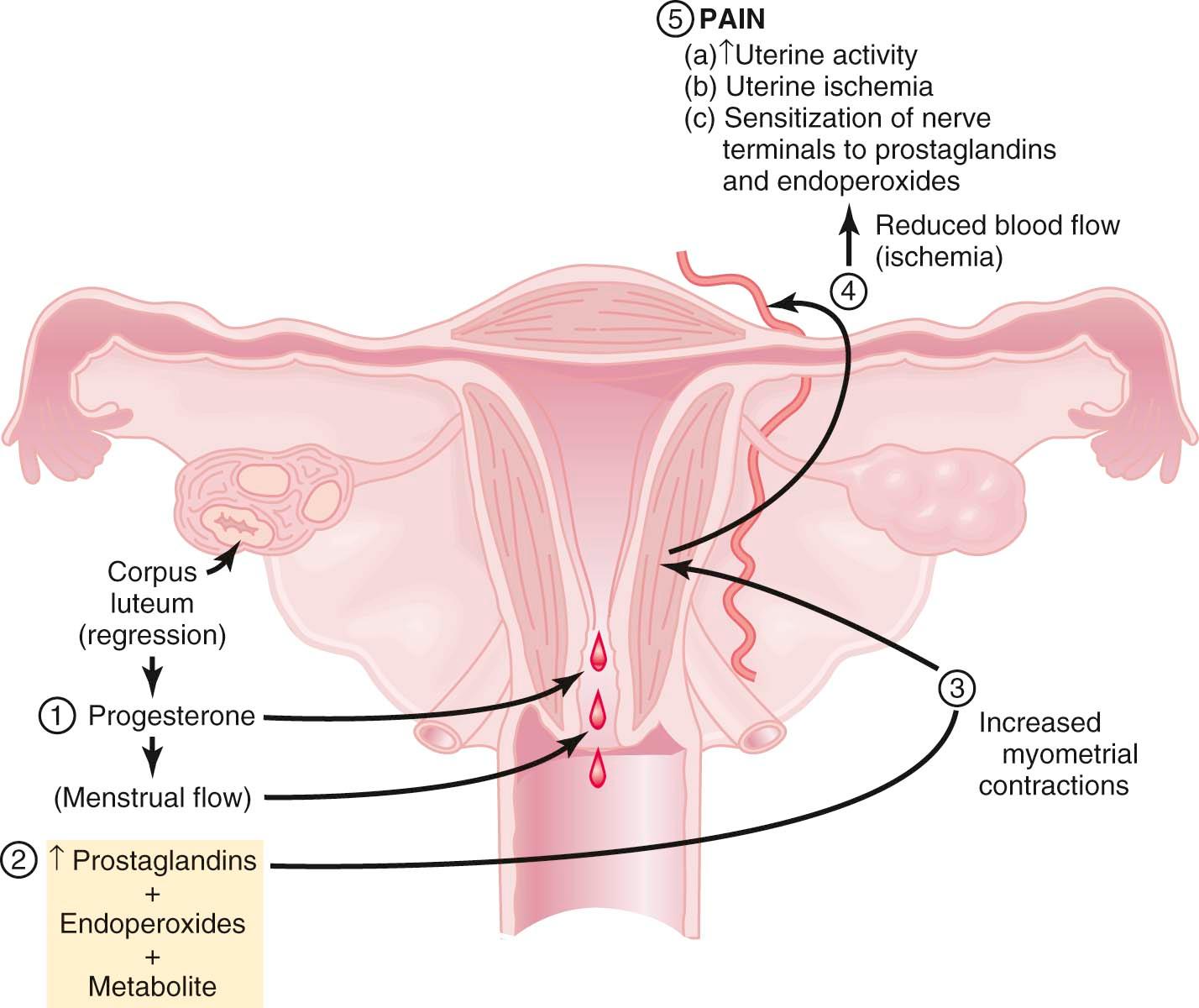 FIGURE 21-2, Postulated mechanism of pain generation in primary dysmenorrhea. Nonsteroidal antiinflammatory drugs inhibit cyclooxygenase, the enzyme that catalyzes the formation of prostaglandins from arachidonic acid. Hormonal contraceptives that block ovulation significantly reduce the formation of prostaglandins. Both drugs can mitigate this mechanism of pain and are effective treatment for primary dysmenorrhea.