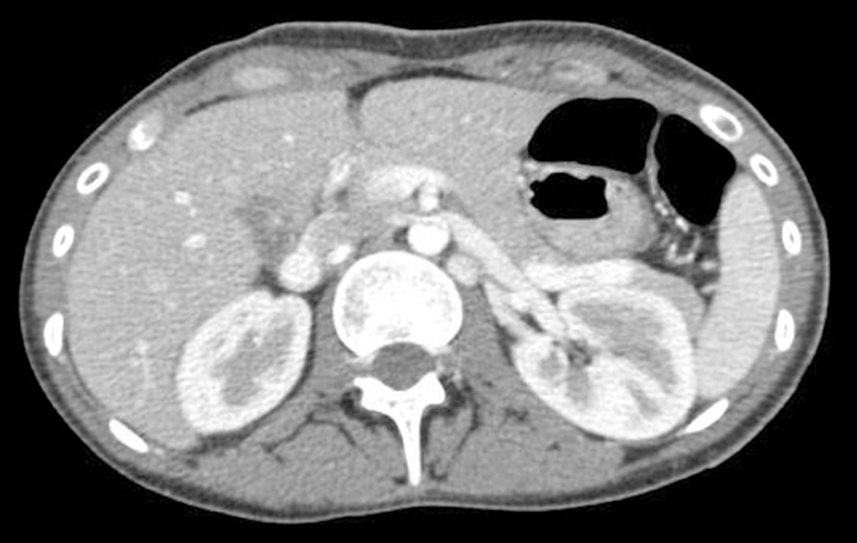 Fig. 21.1, Computed tomography of the abdomen demonstrating compression of the left renal vein. Note the paucity of retroperitoneal fat and steep posterior to anterior course of the left renal vein. The relative importance of compression of the left renal vein by the overlying superior mesenteric artery versus stretching of the vein over the abdominal aorta is unknown.
