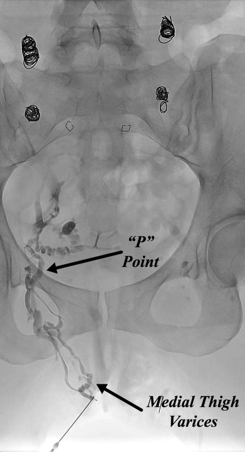 Fig. 21.2, Retrograde venography of medial thigh varices demonstrating the perineal “P” with filling of internal pudendal tributaries of the internal iliac vein.