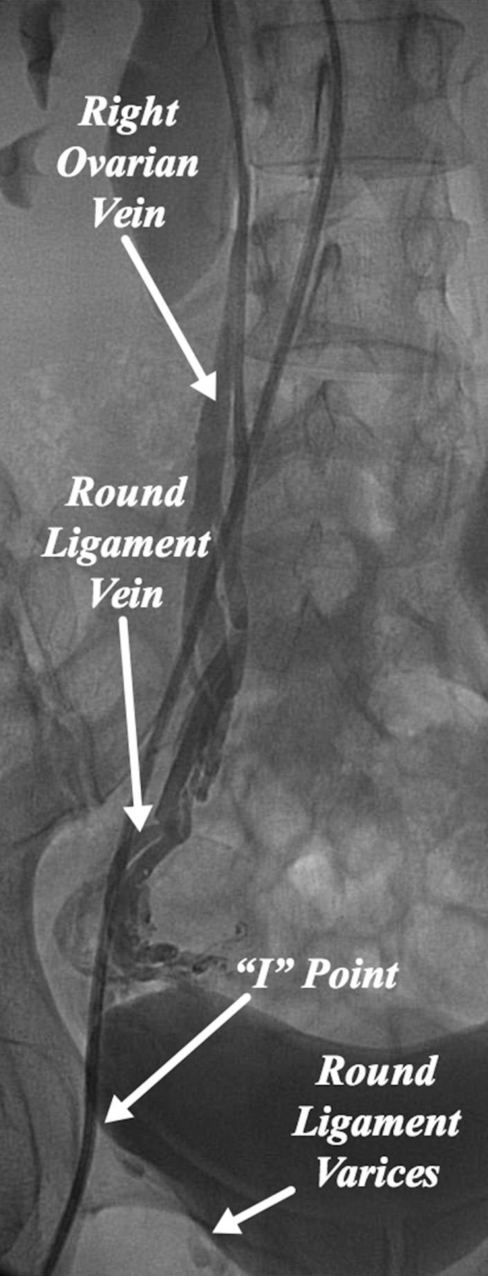Fig. 21.3, Right ovarian venography demonstrating the vein of the round ligament arising from the ovarian vein and passing through the inguinal canal (inguinal “I” point) to communicate with labial varices.
