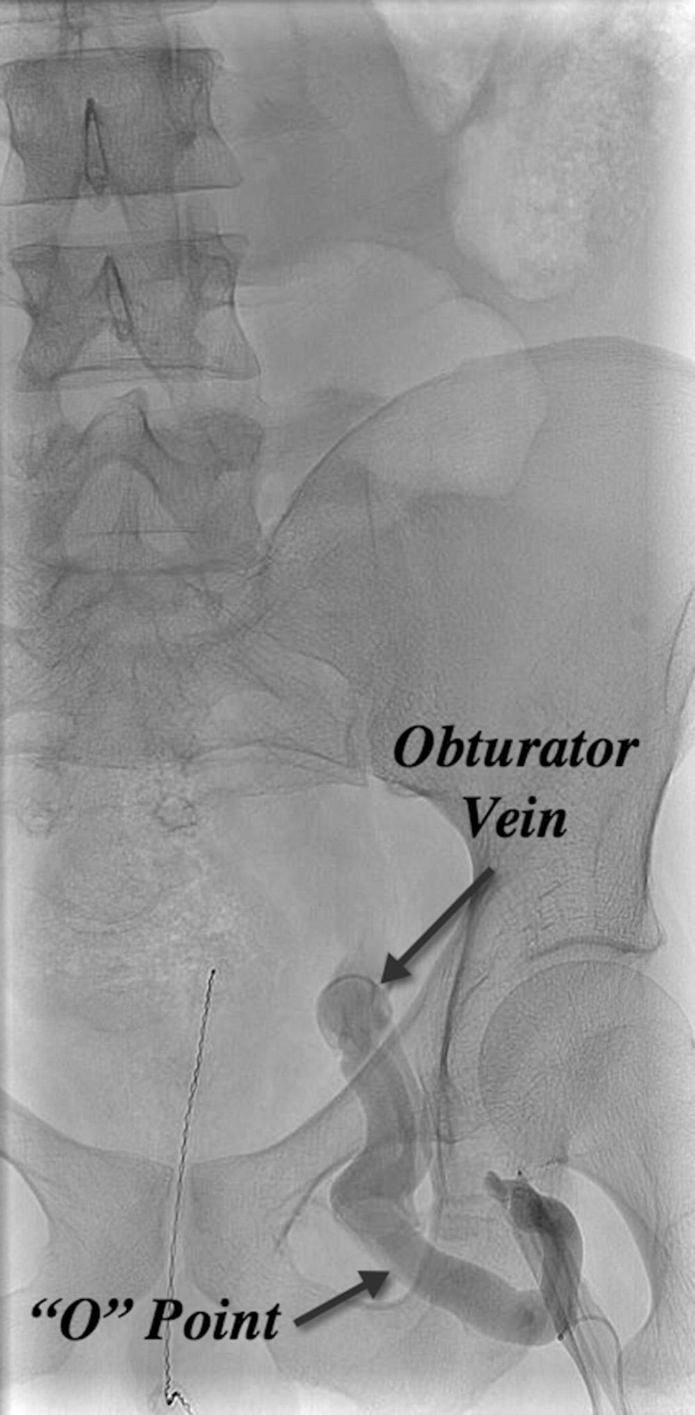 Fig. 21.4, Retrograde venogram demonstrating communication of the great saphenous vein with the obturator tributary of the internal iliac vein through the “O” point.
