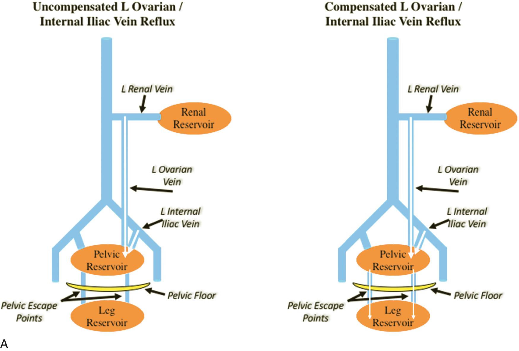 Fig. 21.6, The venous reservoirs of the abdomen and pelvic. Depending on whether pressure is transmitted directly to the distal reservoir or is decompressed via collaterals, individual pathologies (reflux or obstruction) can be classified as “uncompensated” or “compensated.” (A) Primary ovarian/internal iliac reflux. An uncompensated pattern is associated with distension of the pelvic venous reservoir and predominant pelvic symptoms in women. In contrast, decompression via the pelvic escape points is associated with typical or atypical lower-varices, often with few pelvic symptoms. (B) Left renal vein compression. An uncompensated pattern is associated with pressure transmission directly to the renal hilum with the development of hilar varices and symptoms of flank pain and hematuria. If collateral drainage via the left gonadal vein is adequate, a compensated pattern of disease may lead pelvic symptoms in women or a varicocele in men. (C) Left common iliac vein compression. In an uncompensated pattern, elevated upstream pressure is transmitted directly to the leg resulting in pain and edema. In compensated disease, decompression via an incompetent internal iliac vein may be associated with pelvic symptoms.