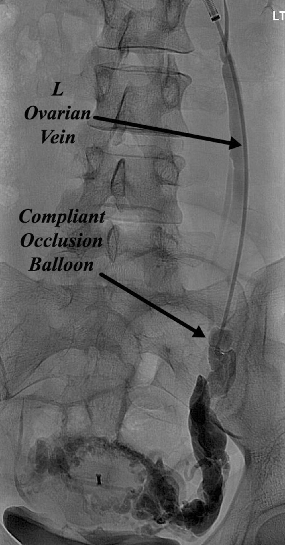 Fig. 21.7, Primary ovarian vein incompetence. The left ovarian vein is markedly dilated and refluxing resulting in periuterine varicosities and pelvic symptoms.