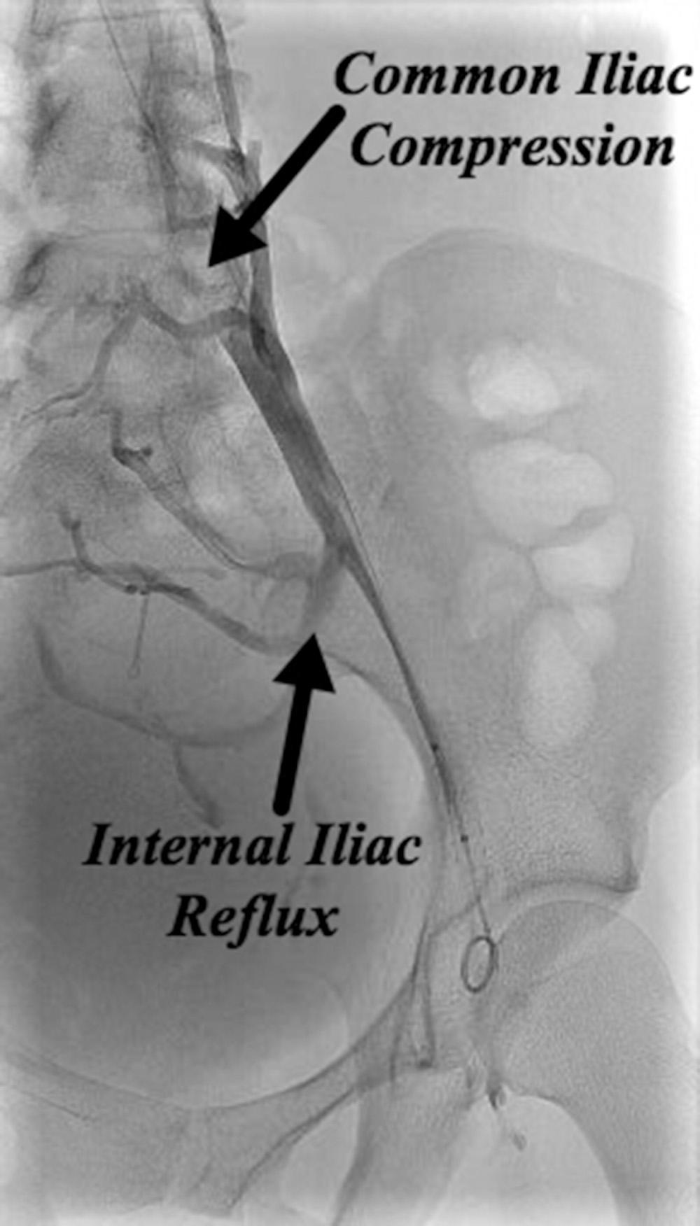 Fig. 21.8, Left common iliac venous compression (May-Thurner syndrome). Elevated pressure upstream from the venous compression is compensated by drainage through the refluxing internal iliac vein and the ascending lumbar vein.