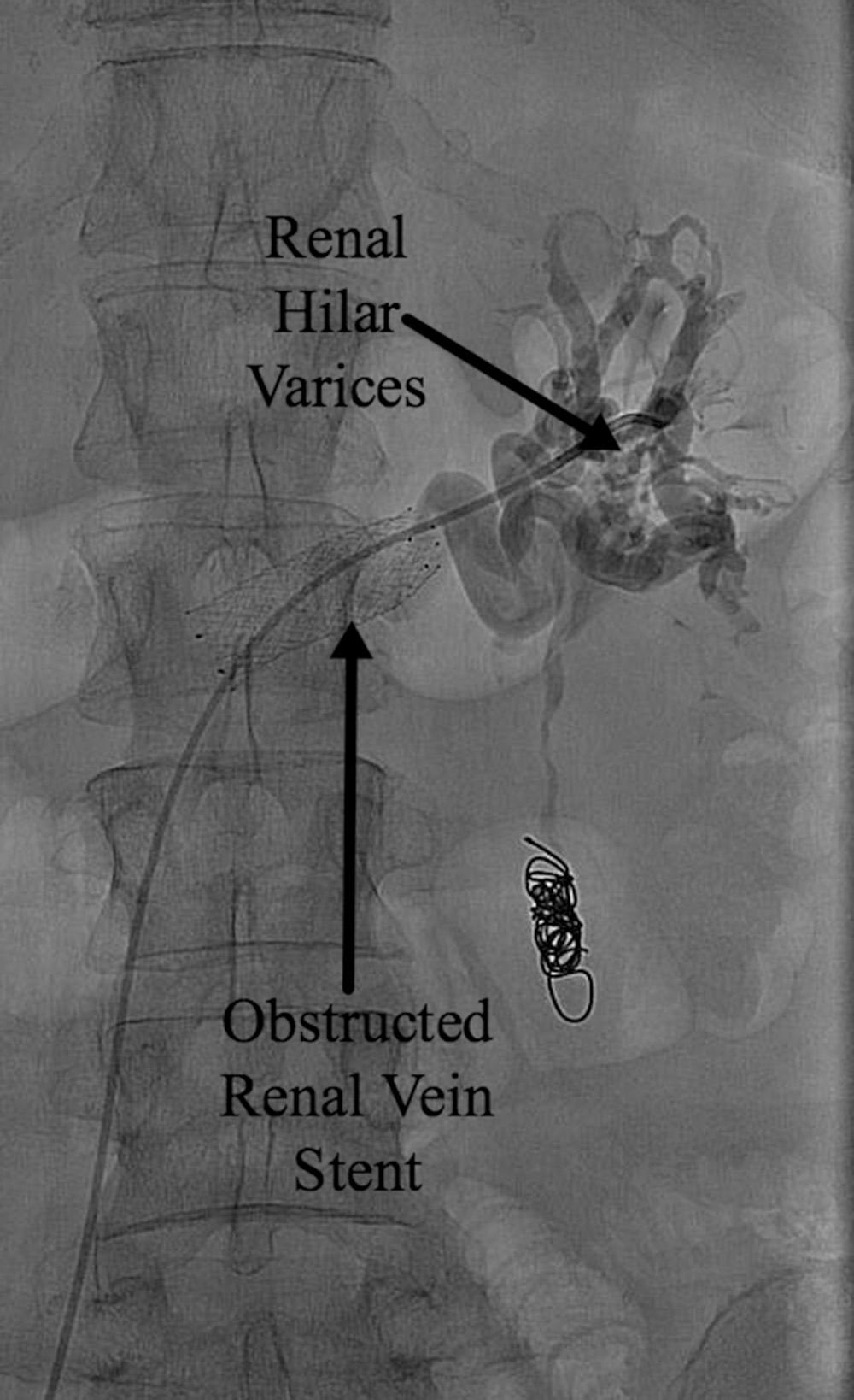 Fig. 21.9, Left renal vein obstruction. The renal vein stent is obstructed with limited collateral outflow from previous left ovarian embolization. There is direct pressure transmission to the renal hilum with the formation of varices and symptoms of flank pain and hematuria. A similar pattern may occur in uncompensated left renal vein compression (nutcracker syndrome).