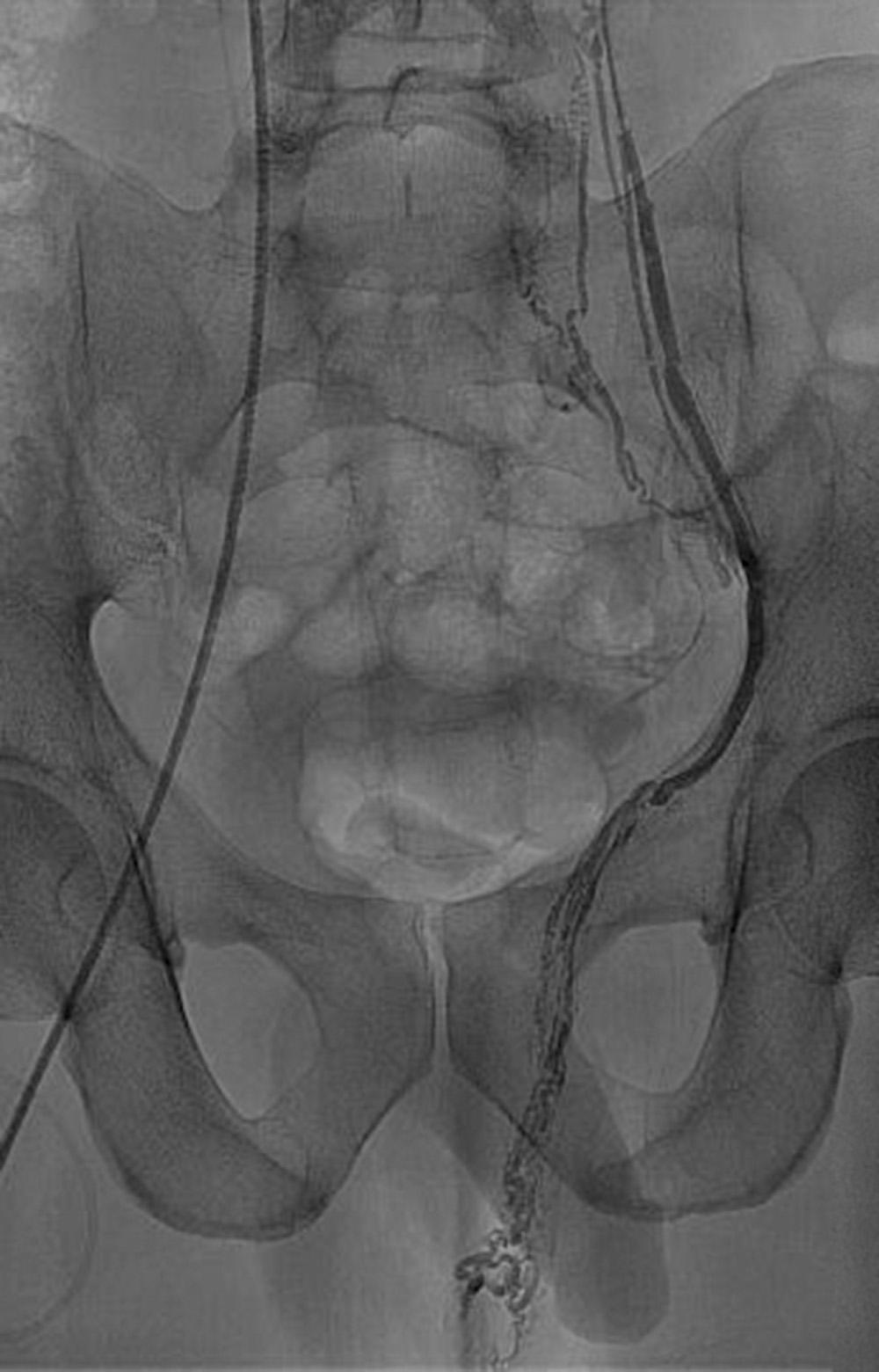 Fig. 21.10, Left-sided varicocele. The gonadal vein in males rarely communicates with tributaries of the internal iliac vein.