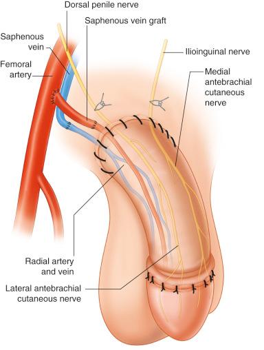 Figure 19.4, Urogenital recipient vessel. Locoregional recipient vessels in the example of a phalloplasty.