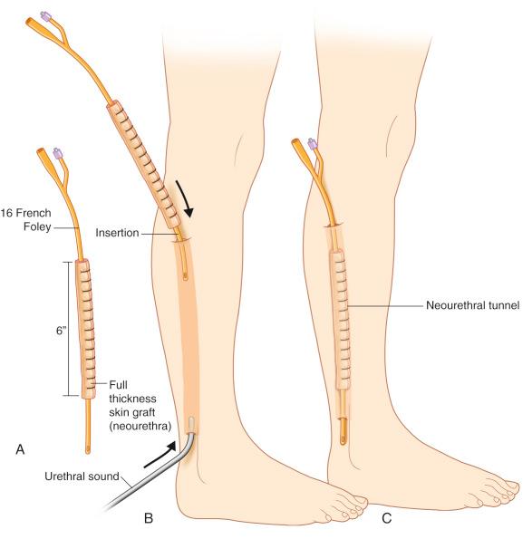 Figure 19.7, (A–C) Prelamination method of urethral reconstruction. Placement of a Foley catheter with a full-thickness skin graft, at the location of the future phalloplasty flap design. Example: free fibula phalloplasty.