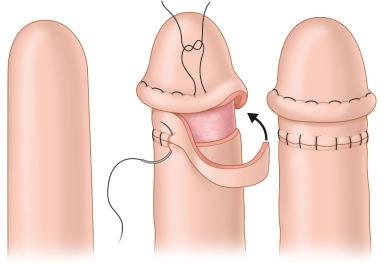 Figure 19.8, Glansplasty. The neoglans is formed by elevating a circumferential epidermal–dermal skin ridge that is folded on itself with interrupted absorbable sutures. The donor site is skin grafted with a small strip of full-thickness skin graft. This will give the appearance of a circumcised glans.