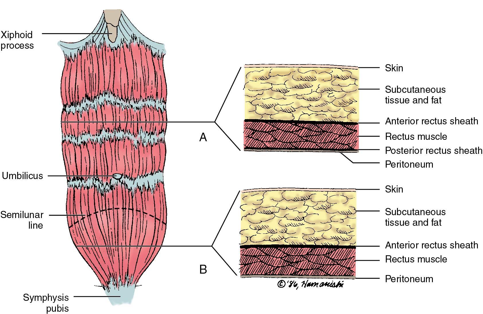 Fig. 20.1, Layers of the abdominal wall. A, Above semilunar line. B, Below semilunar line.