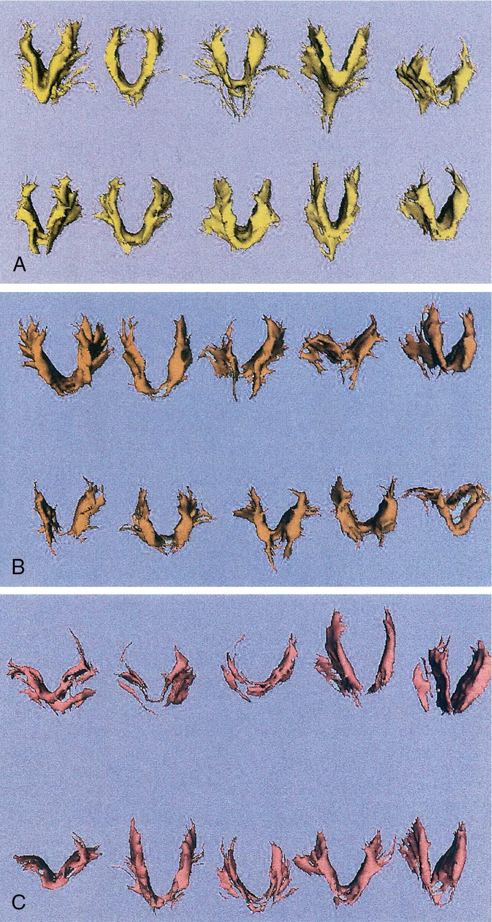 Fig. 20.12, Color images of reconstructed levator ani muscles from three subject groups: ( A ) asymptomatic group, ( B ) stress incontinence group, and ( C ) prolapse group.