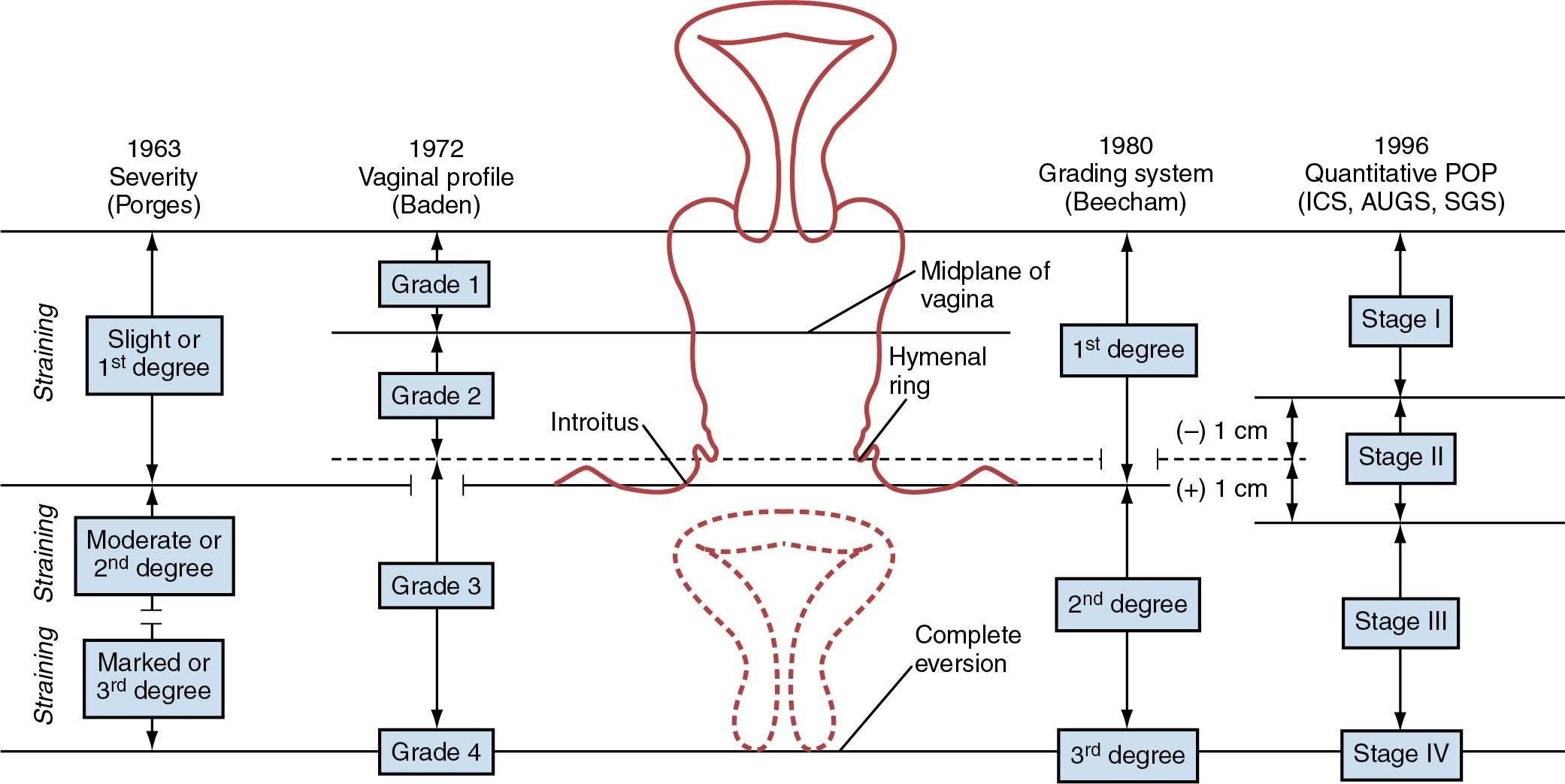 Fig. 20.13, Visual comparison of systems used to quantify pelvic organ prolapse (POP). AUGS, American Urogynecologic Society; ICS, International Continence Society; SGS, Society of Gynecologic Surgeons.