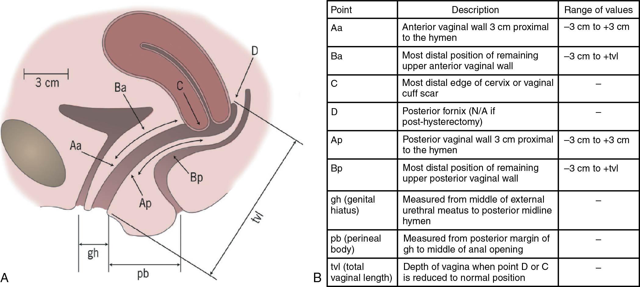 Fig. 20.14, A, Landmarks for the Pelvic Organ Prolapse Quantification System (POP-Q) system. B, POP-Q points of reference.