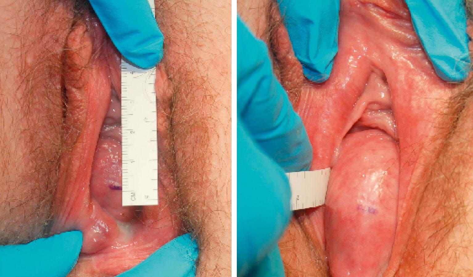 Fig. 20.15, Measuring point Aa. At rest, the Aa point is marked 3 cm proximal to the urethral meatus along the anterior vaginal wall (left). Then the patient is asked to strain, and the location of this point is measure in relation to the plane of the hymenal remnant (right). In this case Aa is equal to +2 cm (2 cm past the hymen). In clinical practice, an imaginary mark is used.