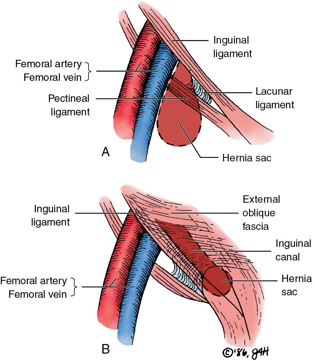 Fig. 20.2, Right femoral ( A ) and right inguinal ( B ) hernias in the female.
