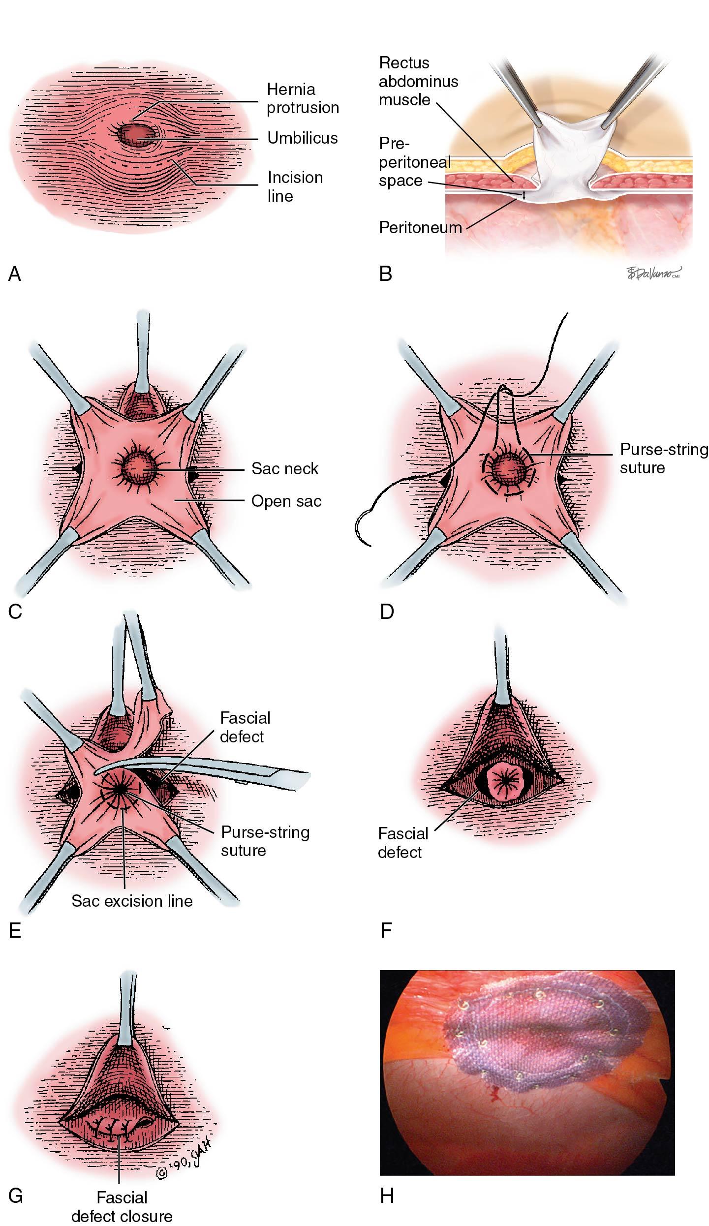 Fig. 20.4, Repair of umbilical hernia. A, Site of incision. B, Umbilicus dissected free of sac and reflected upward. C, Appearance of sac that is cut open. D, Placement of purse-string suture at neck of sac. E, Sac dissected free of fascial defect after suture is tied. F, Appearance of fascial defect after sac has been excised. G, Fascial defect closed; umbilicus will be tacked to it. H, Umbilical hernia repair laparoscopically with mesh. Many umbilical hernia repairs are now done with mesh grafts.