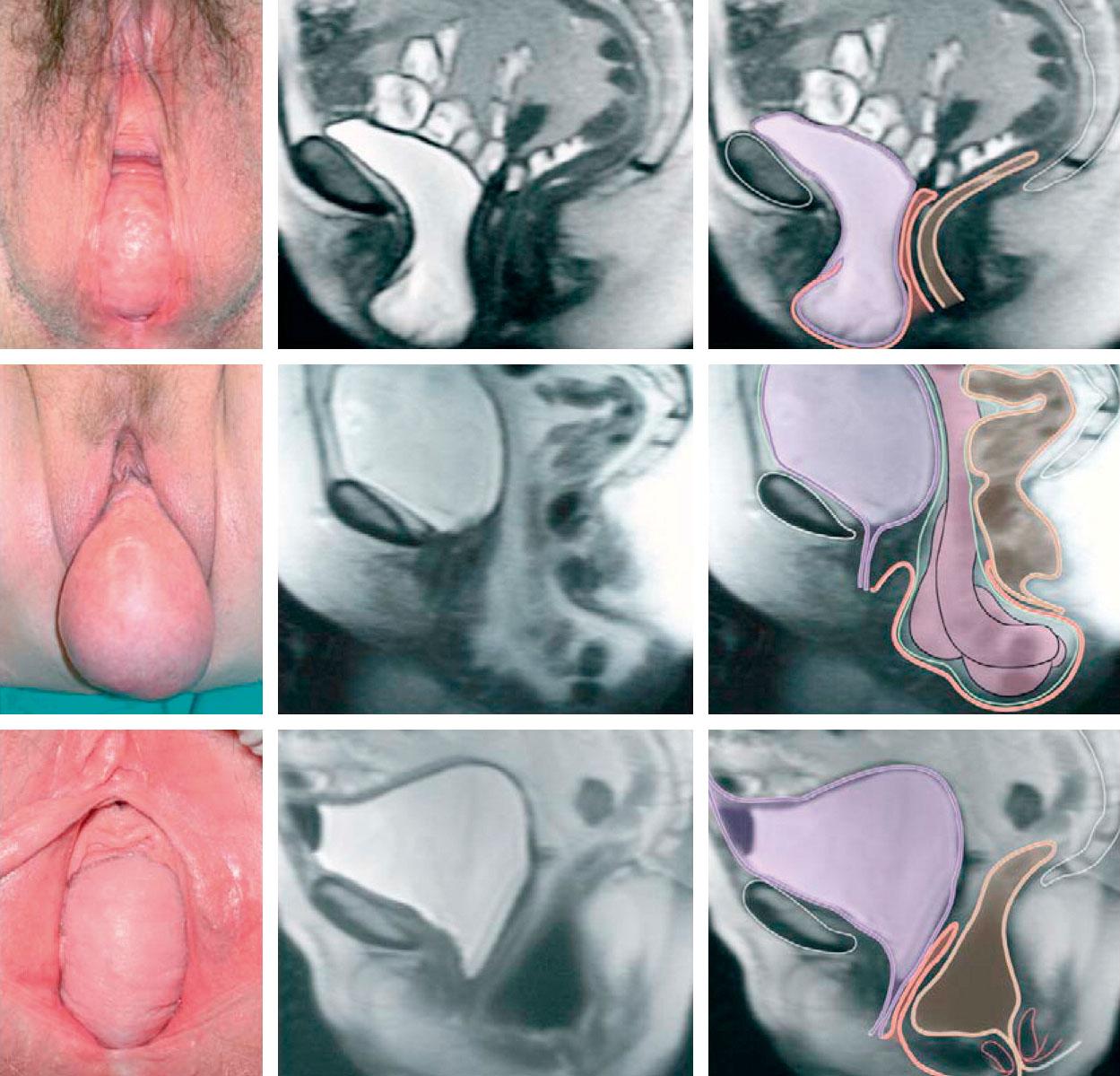 Fig. 20.5, Photographs in lithotomy position and sagittal magnetic resonance images showing vaginal wall prolapse. Prolapse might include (top to bottom): bladder (cystocele), small bowel (enterocele) or rectum (rectocele). Purple: bladder; orange: vagina; brown: colon, and rectum; green: peritoneum.