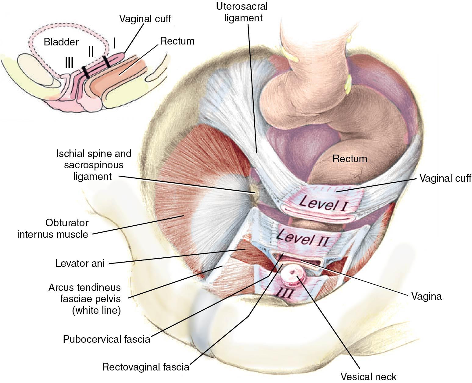 Fig. 20.9, Level I (suspension) and level II (attachment) support of the vagina. In level I the paracolpium (uterosacral ligaments) suspends the vagina from the lateral pelvic walls. Fibers of level I extend both vertically and posteriorly toward the sacrum. In level II support, the vagina is attached to the arcus tendineus fasciae pelvis and superior fascia of the levator ani by condensations of the levator fascia (e.g., endopelvic and pubocervical fascia). In level III support, the vaginal wall is attached directly to adjacent structures without intervening paracolpium (i.e., urethra anteriorly, perineal body posteriorly, and levator ani muscles laterally).