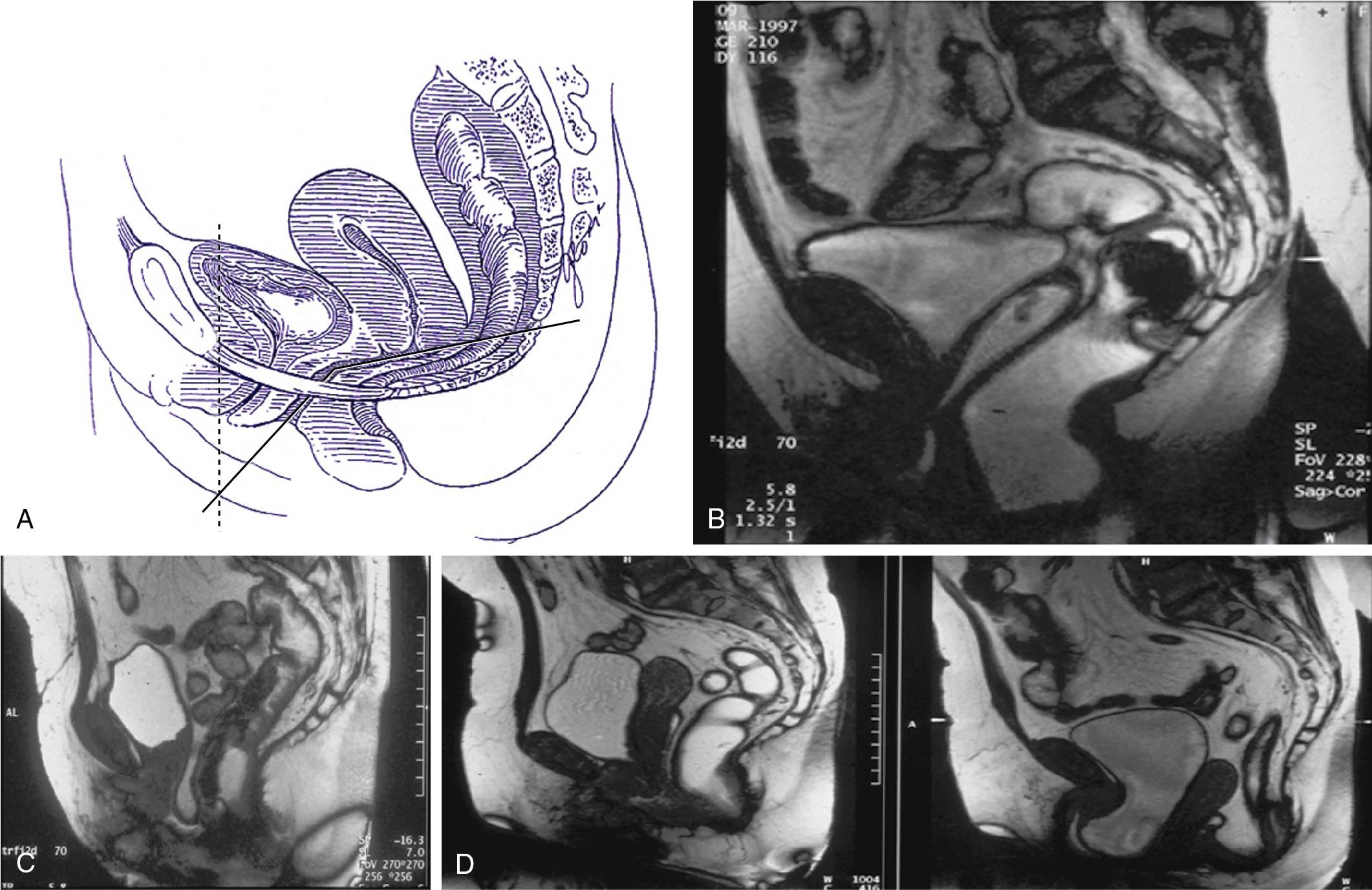 Fig. 20.10, A and B, In the nulliparous patient, the lower one-third of the vagina is oriented more vertically, whereas the upper two-thirds deviate horizontally, thereby maintaining the vaginal axis in an almost horizontal position. C, During stressful maneuvers such as coughing or straining, the levator hiatus is shortened anteriorly by contraction of the pubococcygeus muscles. D, In the case of genital prolapse when the levator ani support is lost, the vaginal axis becomes more vertical, the urogenital hiatus broadens, and fascial supports are strained.