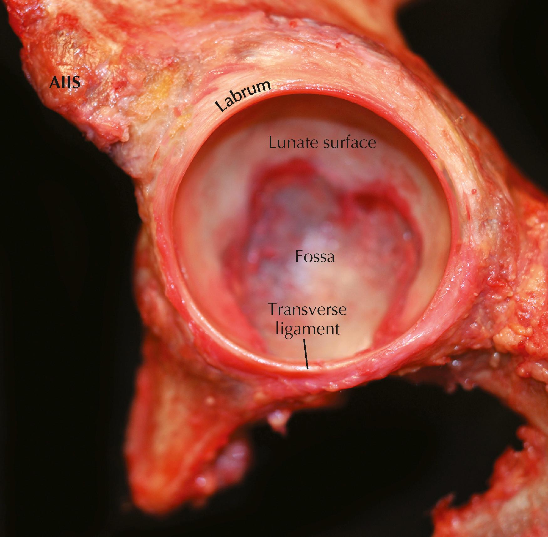 Figure 54.1, Cadaveric image of a left hip demonstrating osseous and soft tissue (including the labrum and the transverse ligament) components of the acetabulum. AIIS, Anterior inferior iliac spine.