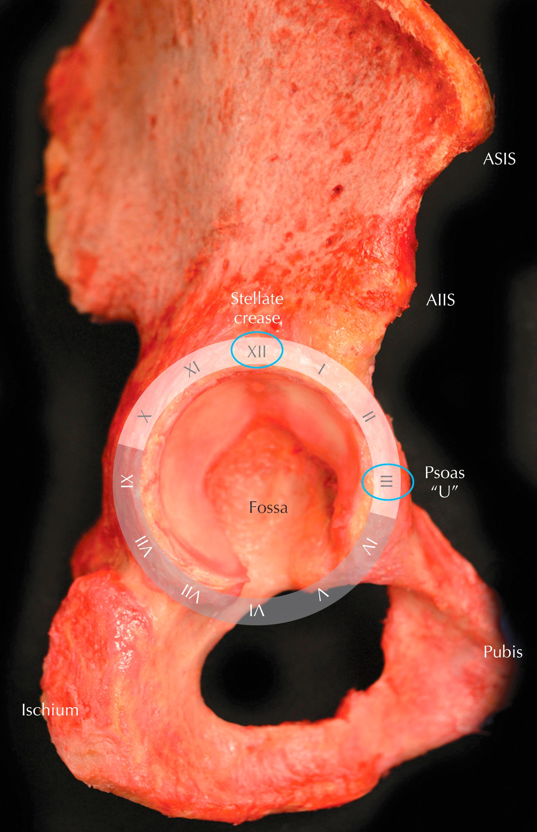 Figure 54.2, Cadaveric image of a right hip showing the most relevant osseous landmarks in hip arthroscopy and their position using a superimposed clock. AIIS, Anterior inferior iliac spine; ASIS, anterior superior iliac spine.