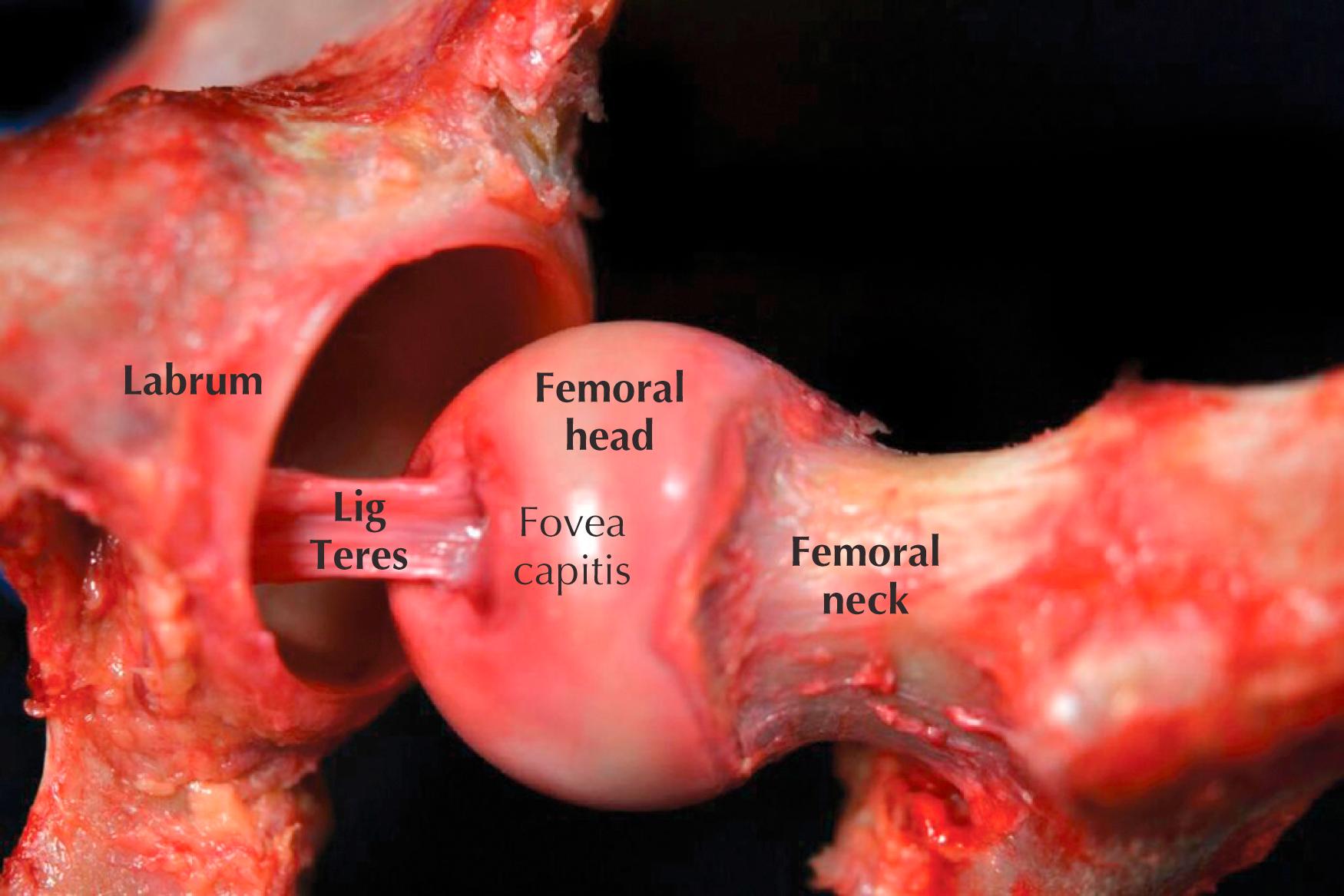 Figure 54.4, Cadaveric image of a left hip under distraction demonstrating its anatomic relationship with the acetabulum. The ligamentum teres is in tension.