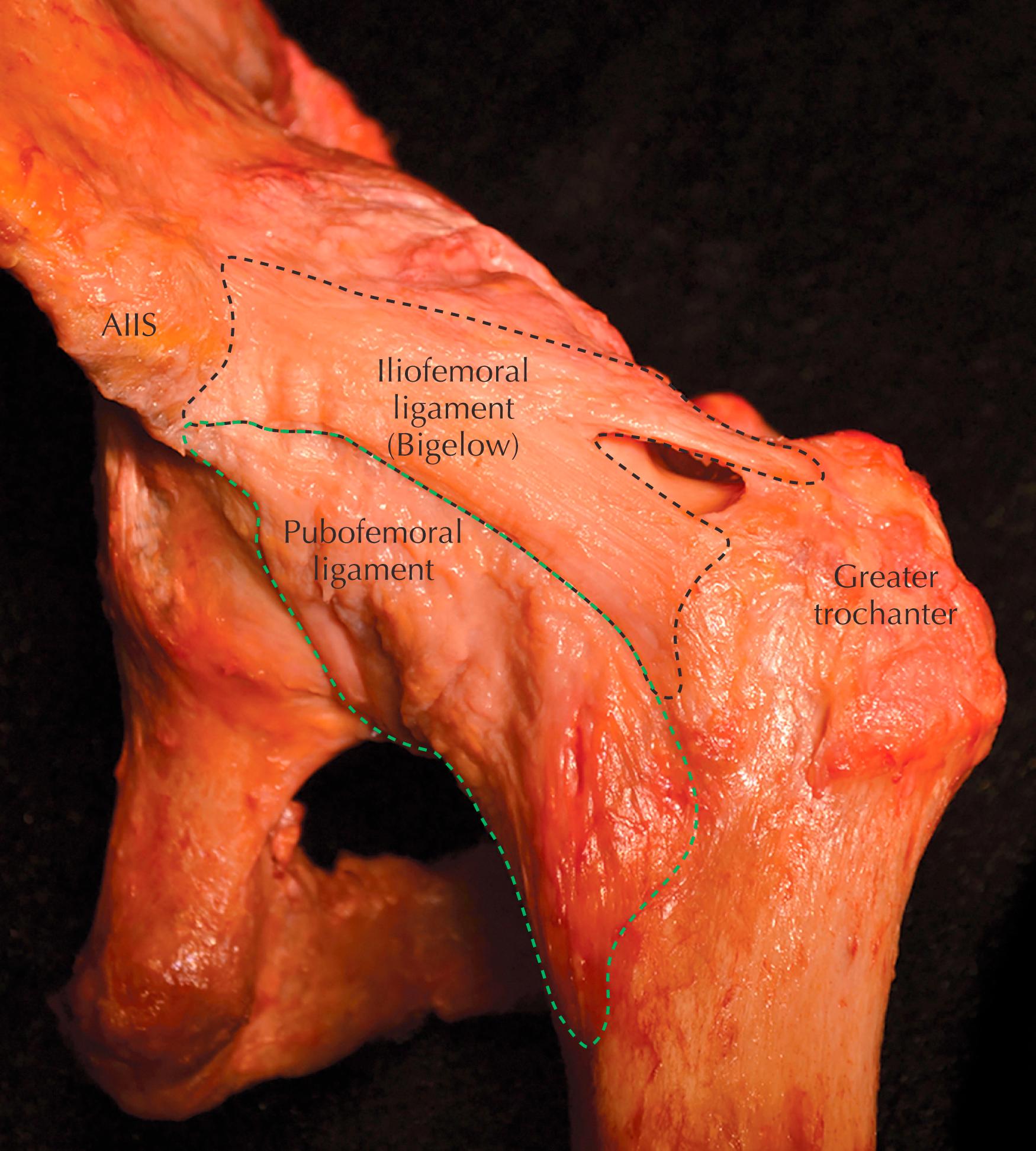 Figure 54.5, Cadaveric image of a left hip showing the different parts of the hip capsule. The iliofemoral ligament is demarcated in black and the pubofemoral ligament in green. The iliofemoral ligament is normally incised during arthroscopy in an interportal or T-shaped fashion.