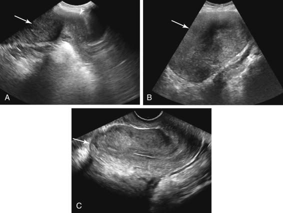 F igure 23-1, Large fibroid only seen on transabdominal (TA) ultrasound. A and B, Longitudinal midline TA images of the pelvis (A) and the mid abdomen (B) demonstrate a large, solid exophytic fibroid (arrows) arising from the uterine fundus (arrowhead) and extending into the abdomen. C, Longitudinal midline transvaginal (TV) image of the uterus (arrow) in the same patient fails to clearly demonstrate the large fibroid because the majority of the mass is located beyond the field of view of the TV transducer.