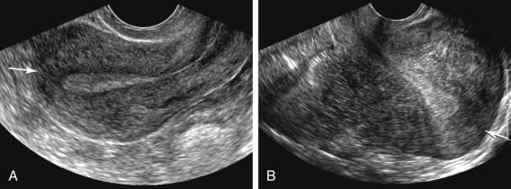 F igure 23-11, Transvaginal longitudinal ultrasound images of an anteverted (image A ) and a retroverted (image B ) uterus, similar to orientation of the diagrams depicting uterine orientation as displayed on the monitor on the right side of Fig. 23-10 . The fundus of the anteverted uterus ( arrow , image A ) is directed toward the left side of the image and the fundus of the retroverted uterus ( arrow , image B ) is directed toward the right side of the image.