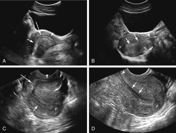 F igure 23-12, Retroflexed versus retroverted uterus. A, Retroflexed uterus: transabdominal (TA) ultrasound. Longitudinal image of the uterus shows the uterine fundus (F) directed posteriorly due to curvature (long arrow) between the cervix (arrowhead) and body (short arrow) of the uterus. B, Retroverted uterus: TA ultrasound. Longitudinal image of the uterus shows the fundus (F) directed posteriorly in the absence of a flexion between the cervix (arrowhead) and body (arrows) of the uterus. C, Retroflexed uterus: transvaginal (TV) ultrasound. Longitudinal image of the uterus shows the fundus (F) directed posteriorly toward the right side of the image due to curvature (long arrow) between the cervix (arrowhead) and body (short arrow) of the uterus. Note that the uterine body appears to be folded up against the cervix. D, Retroverted uterus: TV ultrasound. Longitudinal image of the uterus shows the fundus (F) directed posteriorly toward the right side of the image in the absence of a flexion between the cervix (arrowhead) and body (arrows) of the uterus.