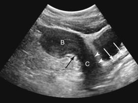 F igure 23-13, Uterus: anteverted and retroflexed. Longitudinal transabdominal image of the uterus shows anteversion (white arrowheads) of the cervix (C) relative to axis of the vagina (white arrows). In addition, there is posterior curvature (black arrow) between the cervix and uterine body (B) consistent with retroflexion.