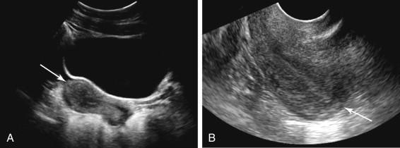 F igure 23-14, Different uterine orientation on transabdominal (TA) and transvaginal (TV) sonography. Longitudinal images of the uterus during a single ultrasound examination show the uterus is anteverted with the fundus (arrow) directed anteriorly at TA ultrasound (image A ), whereas the uterus is retroverted with the fundus (arrow) directed posteriorly toward the right side of the image at TV ultrasound (image B ). Uterine orientation is occasionally different on the TA and TV examinations, due to the effects of bladder distention and transducer pressure.