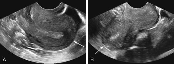 F igure 23-15, Uterine orientation changes during transvaginal (TV) sonography. Longitudinal images of the uterus obtained at different times during a single TV sonogram show change in uterine orientation from retroflexed (image A ) with the fundus (arrow) directed toward the right side of the image near the beginning of study to anteverted (image B ) with the fundus (arrow) directed toward the left side of the image near the end of the sonogram. Uterine orientation changes during the course of a single transvaginal examination are uncommon, and when seen are likely attributable to the effects of transducer pressure on the cervix.