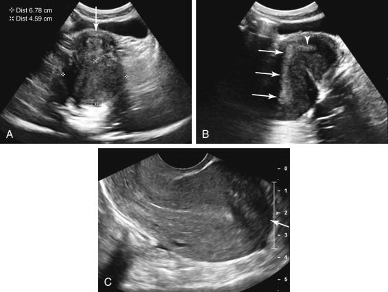 F igure 23-16, Retroflexed uterus resulting in spurious appearance of a posterior fibroid. A, Axial transabdominal (TA) image of the uterus shows an apparent mass (cursors) posterior to the uterus (arrow) . B, Longitudinal TA image of the same patient as in image A , with scan plane adjusted to best depict the endometrium, shows no evidence of a fibroid. Instead a retroflexed uterus is demonstrated with flexion between the cervix (arrowhead) and endometrium (arrows) . The endometrium extends posteriorly into the area mistaken for a fibroid in image A . C, Longitudinal transvaginal image of the uterus in the same patient confirms a retroflexed uterus, with the uterine fundus (arrow) directed toward the right side of the image, and no evidence of a fibroid.