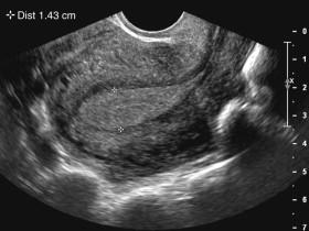 F igure 23-17, Endometrium: measurement. Sagittal midline transvaginal (TV) image of the uterus shows technique for endometrial measurement. The anteroposterior diameter of the endometrium should be measured on a midline sagittal TV image, perpendicular to the long axis of the endometrium (cursors) .