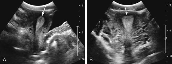 F igure 23-18, Spurious appearance of endometrial thickening due to scan plane. A, Midline transabdominal (TA) sagittal image of the uterus during the secretory stage of the menstrual cycle shows normal-appearing endometrial thickness (arrow) in the sagittal scan plane. B, Coronal TA image of the uterus obtained during the same ultrasound examination shows spurious appearance of endometrial thickening (arrow) compared with image A . Endometrial thickness should be assessed in the sagittal scan plane; the endometrium is thicker in coronal and oblique scan planes than in the sagittal scan plane.